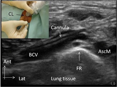 fig 1_BCV