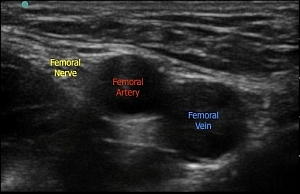 Figure 2: Sonoanatomy of the femoral nerve